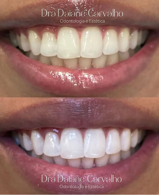Resultado de clareamento dental, caso 1, realizado no consultório da Dra. Daiane Carvalho na Barra Funda, São Paulo
