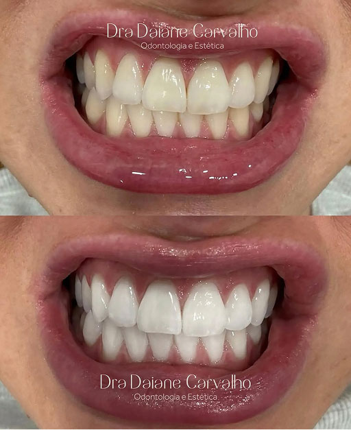 Resultado de clareamento dental, caso 4, realizado no consultório da Dra. Daiane Carvalho na Barra Funda, São Paulo