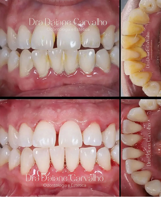 Resultado de clareamento dental, caso 5, realizado no consultório da Dra. Daiane Carvalho na Barra Funda, São Paulo